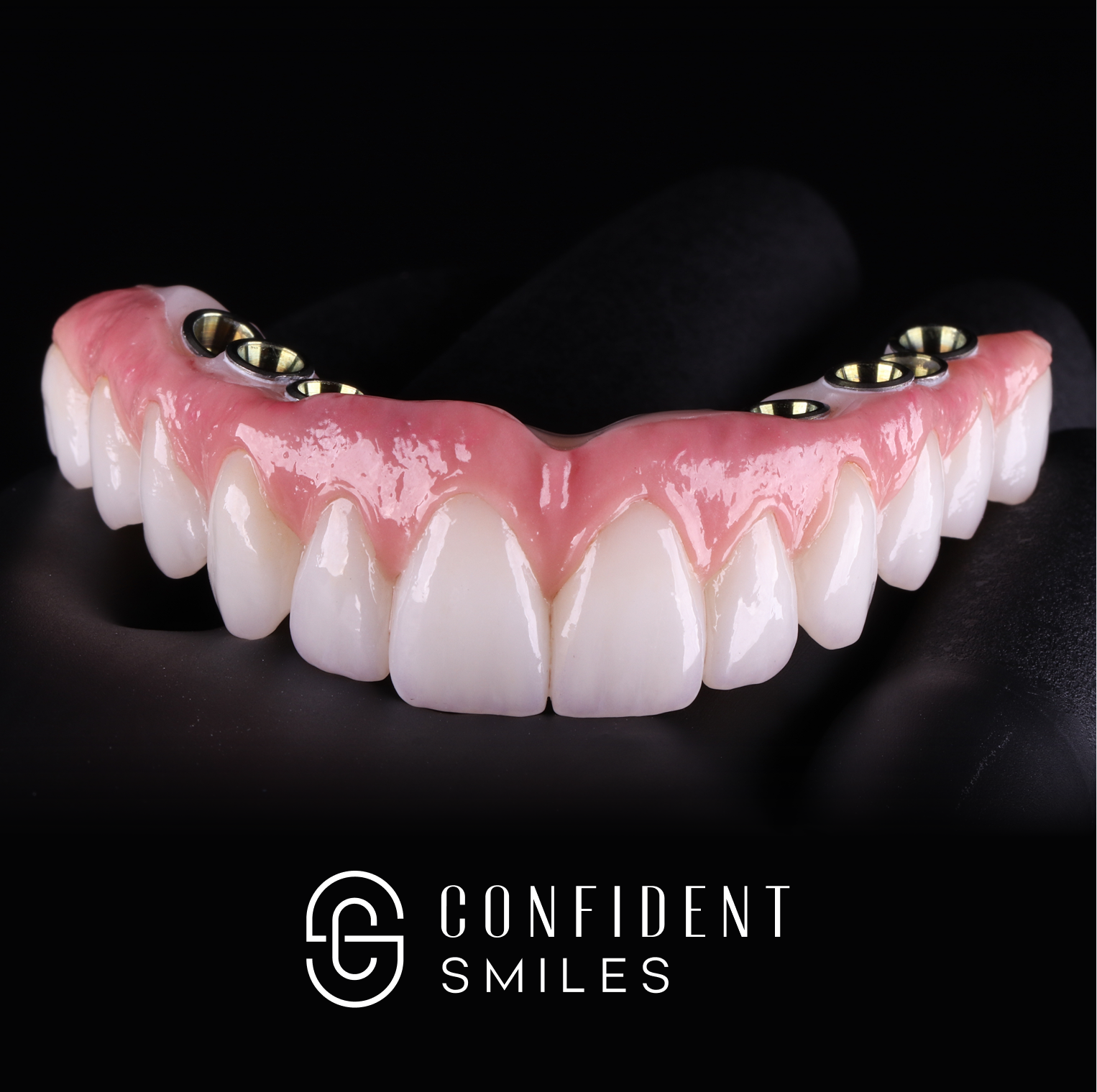 Hybrid Implant Bridge