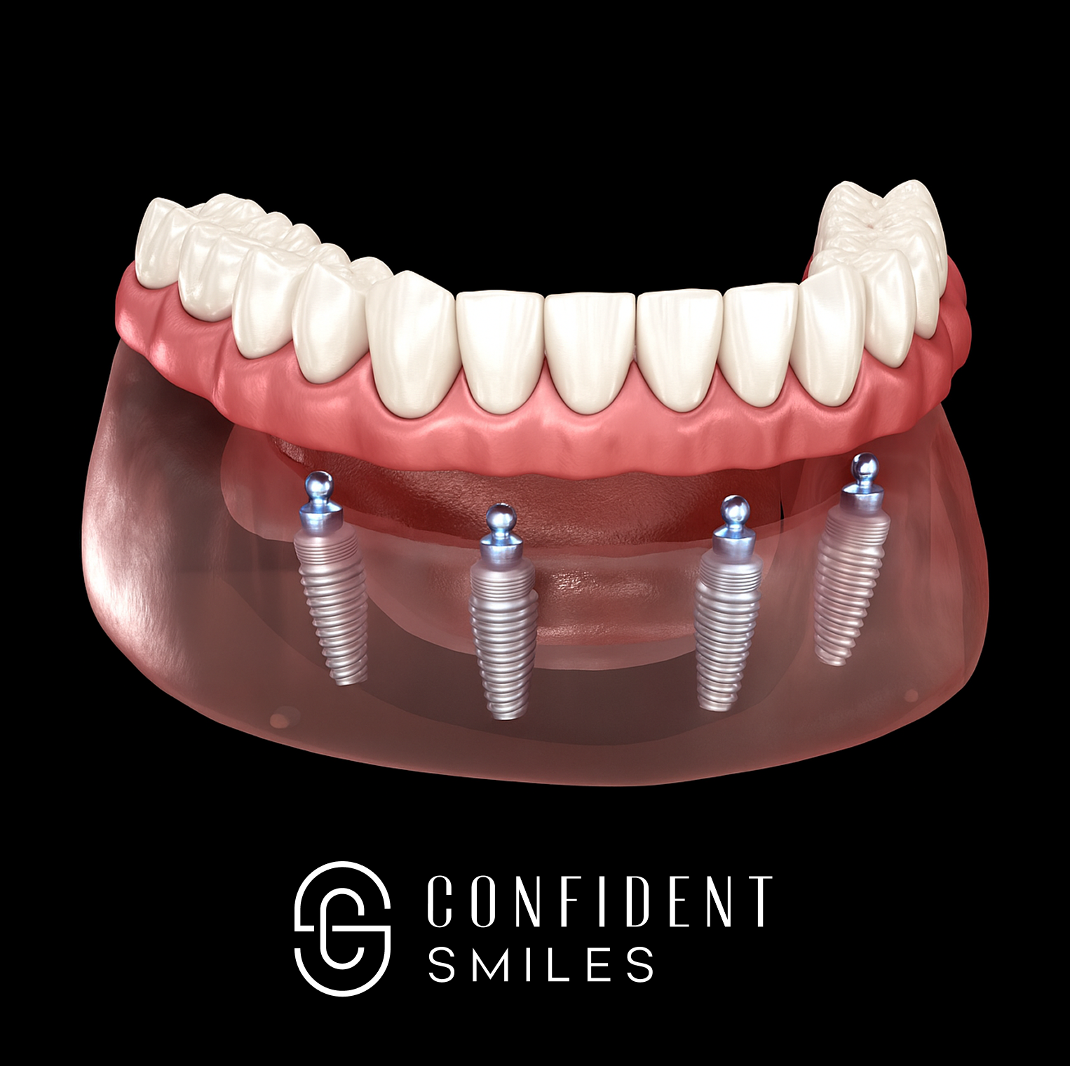 Zirconia Implant Bridge